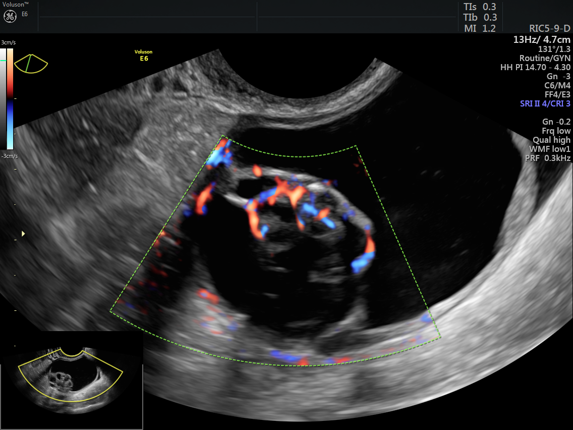 Using Color Doppler To Classify Ovarian Tumors Empowered Womens Health 5072