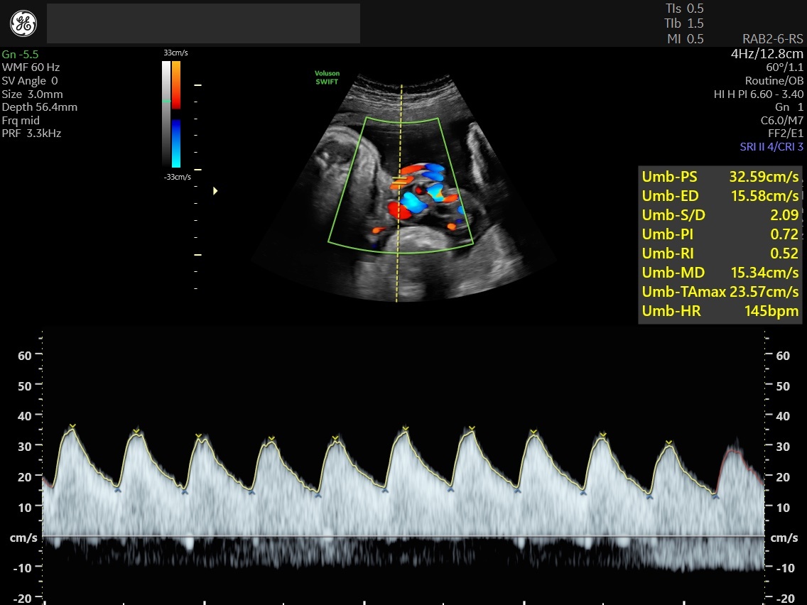 Umbilical Artery Doppler Assessment: A How-To Guide | Empowered Women's ...