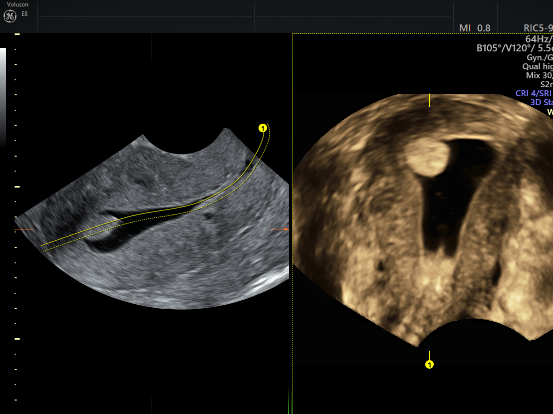 Endometrial Polyp Ultrasound 3d | Hot Sex Picture