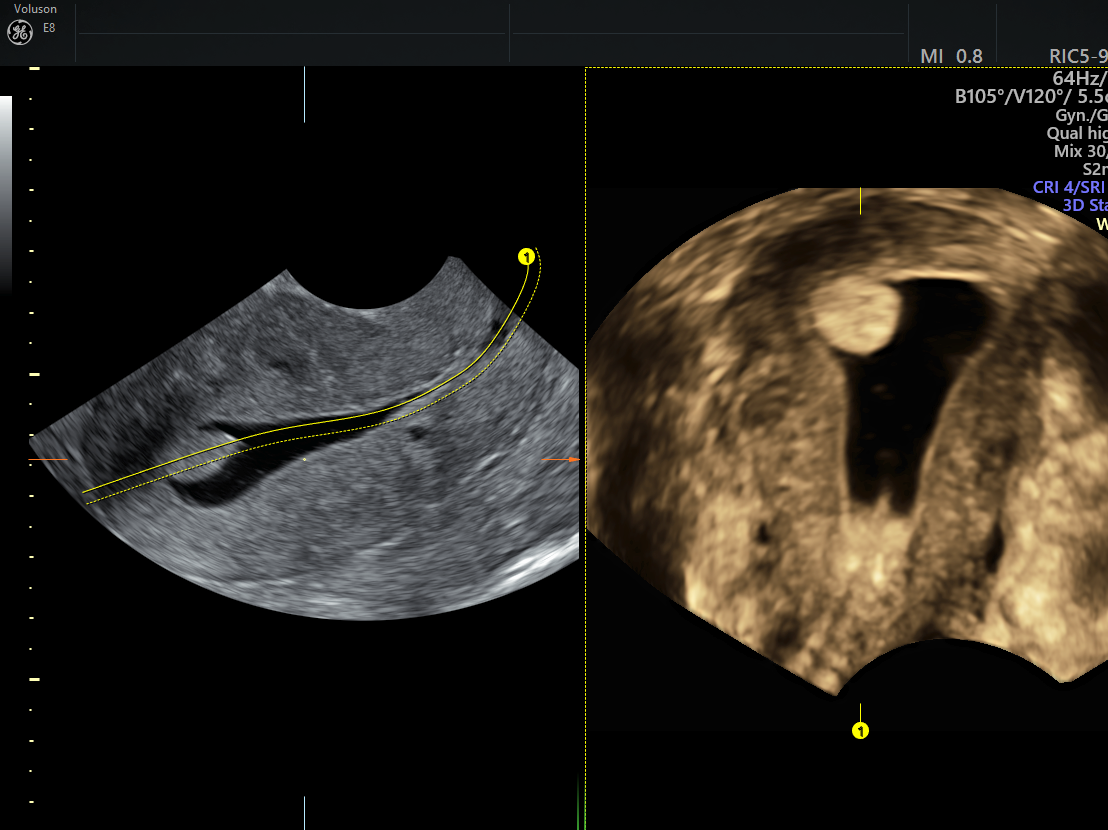 Endometrial Polyp Ultrasound And Sis The Gold Standard Empowered Womens Health 