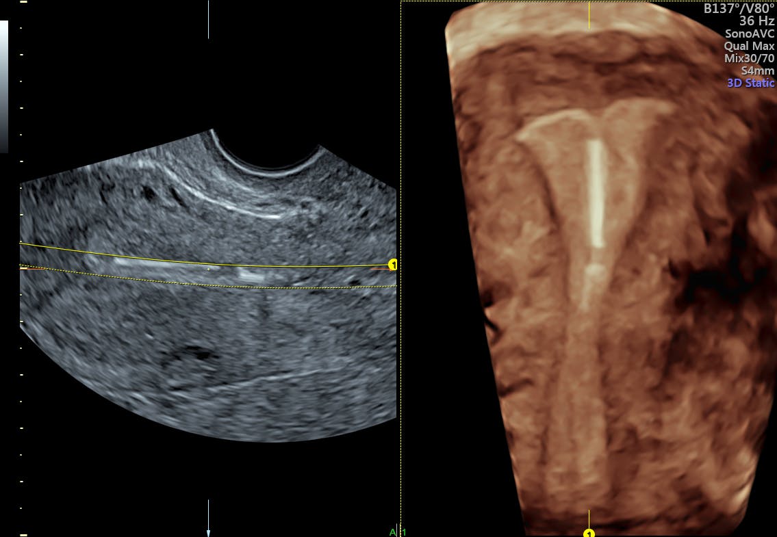 IUD Pain & Misplacement: Diagnosing with 3D Ultrasound ...