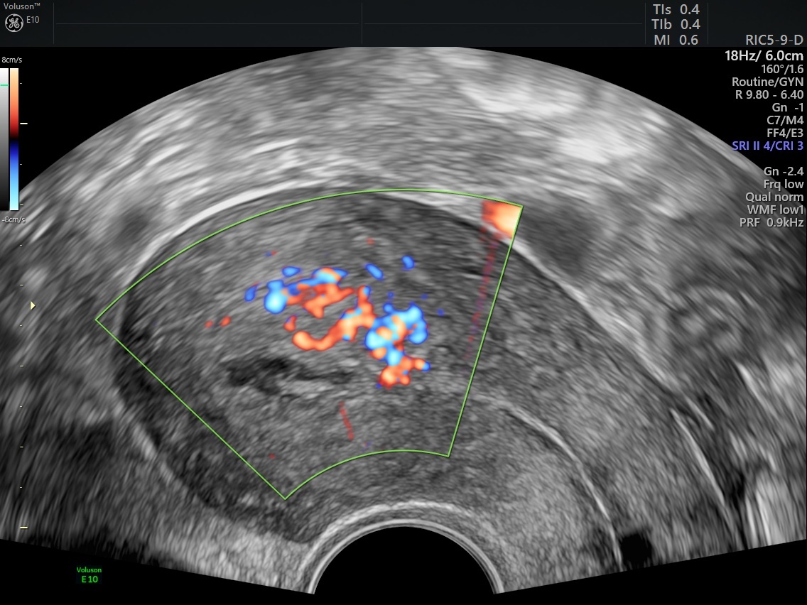 How Retained Products of Conception Can Impact Fertility Empowered Women's Health