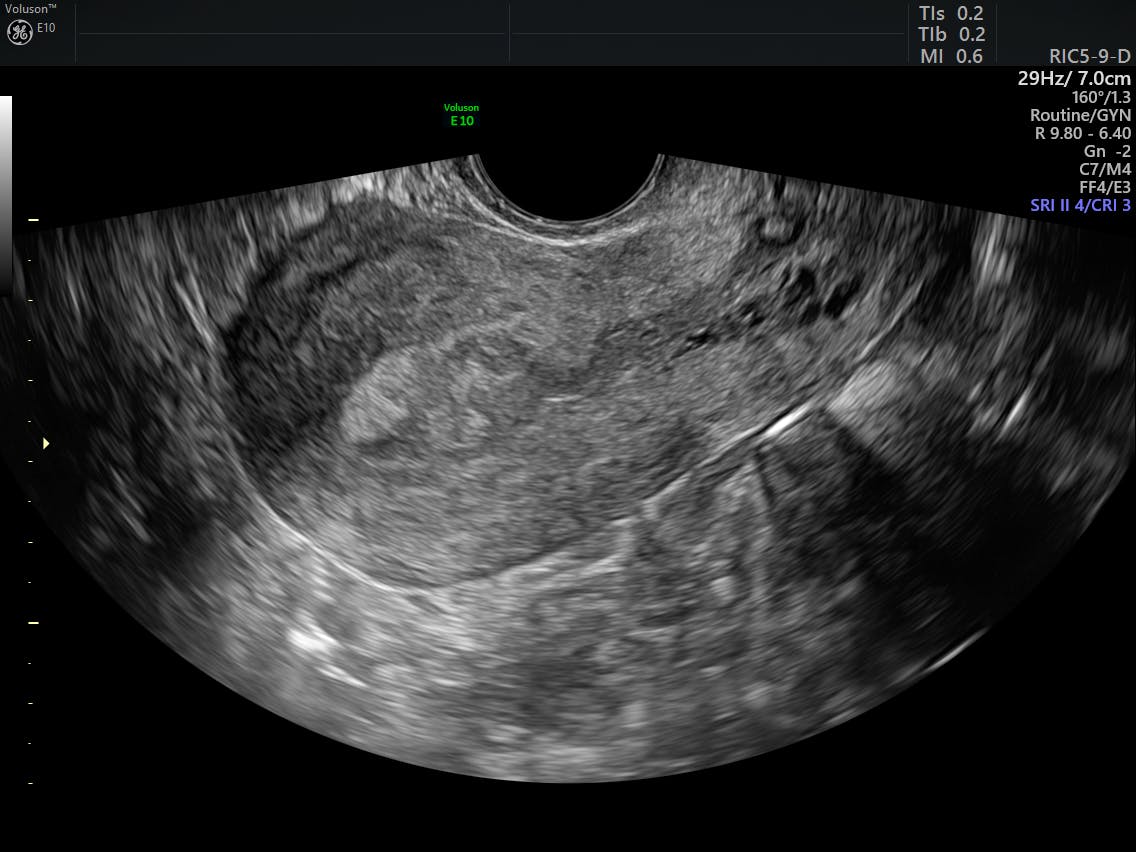 Detecting Endometrial Carcinoma with Ultrasound | Empowered Women's Health