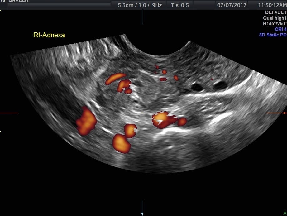 Diagnosing Ovarian Torsion With Ultrasound | Empowered Women's Health