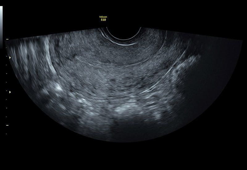 Ultrasound Post Menopausal Bleeding Empowered Women's Health