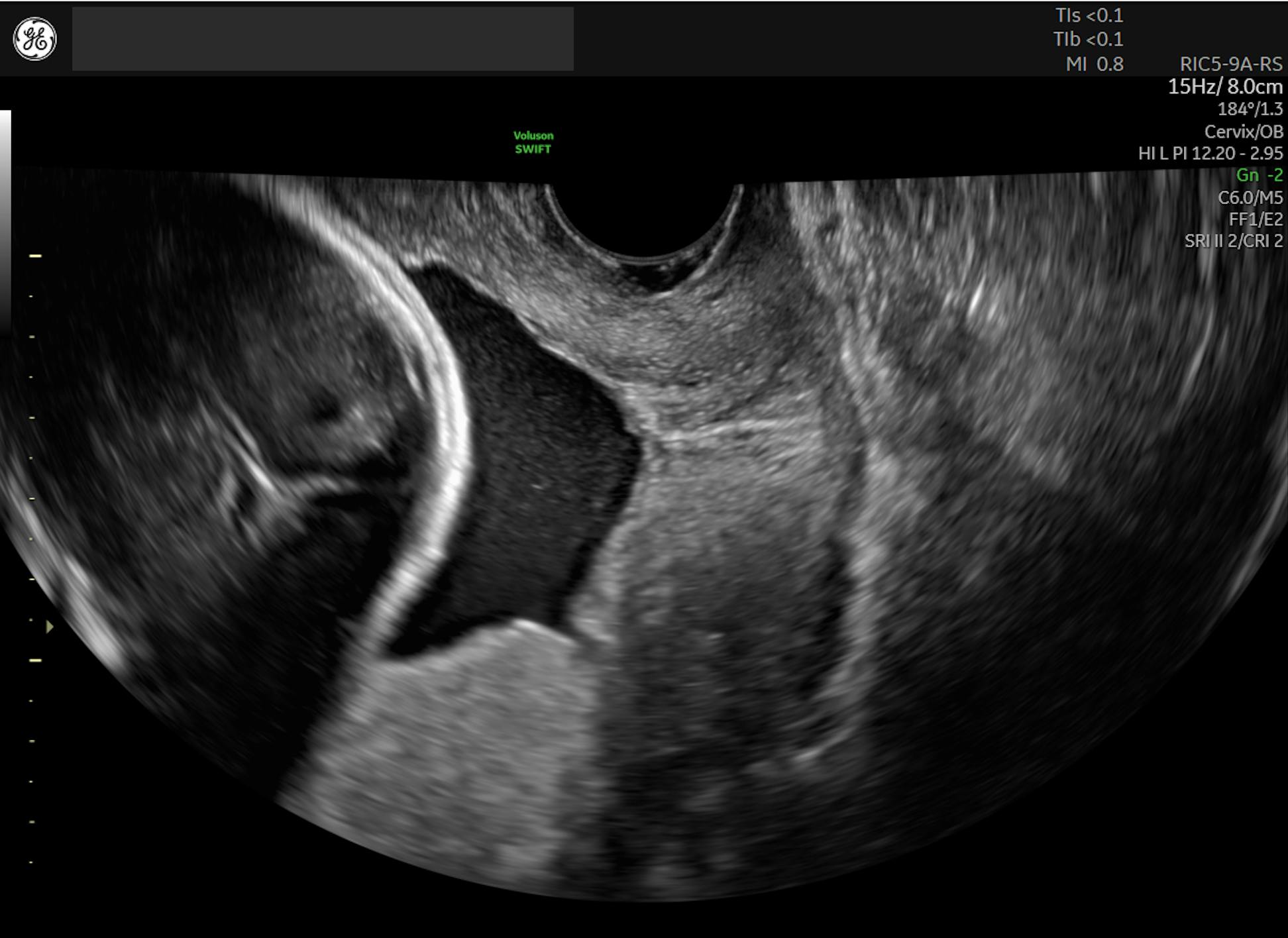 Does Bloody Show in Late Pregnancy Mean Labor is Starting?, image size:1944x1416