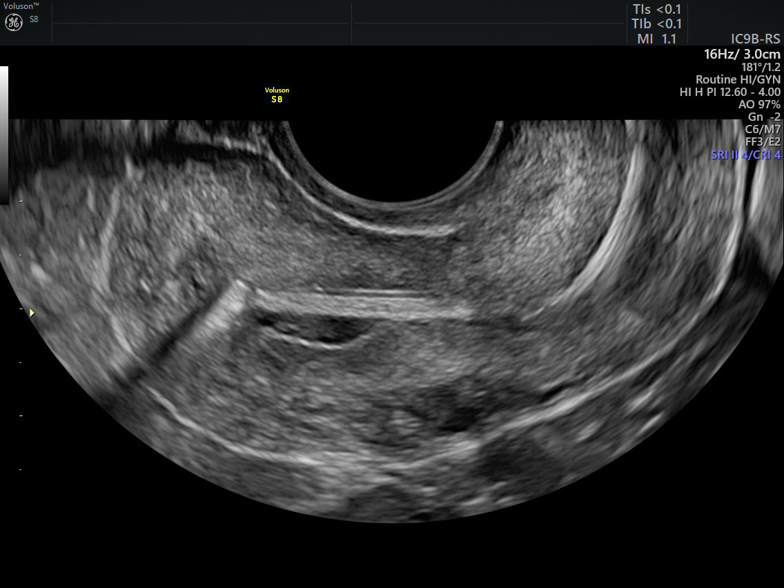 Uterus Anatomy Diagram With Iud