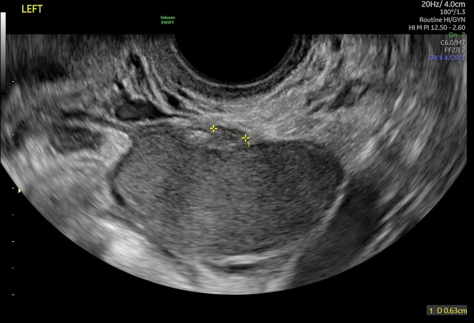 If Endometriosis Is Suspected, Should You Perform a Kidney Ultrasound