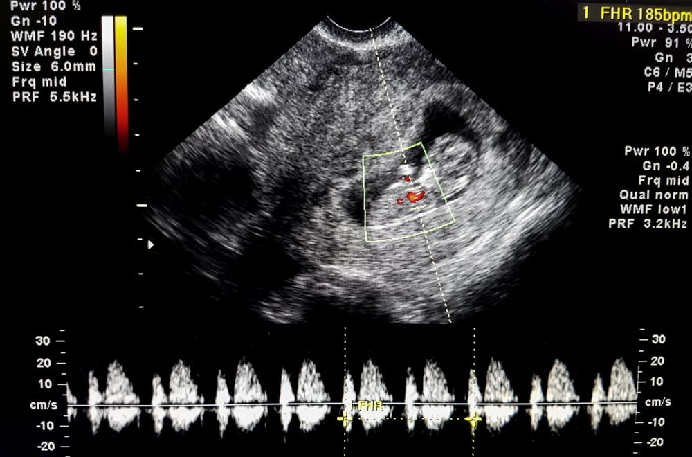 Using a Blood Test and Ultrasound to Confirm Pregnancy