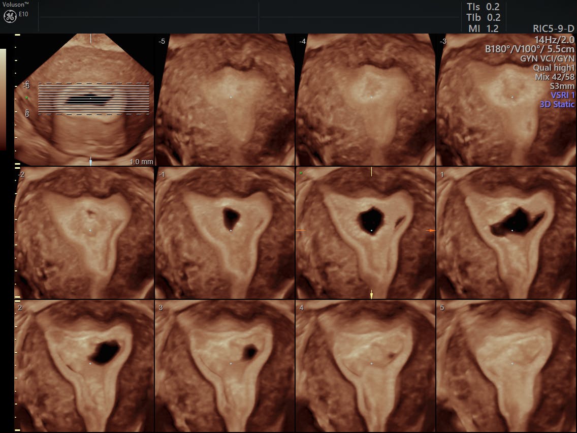 Patients Prefer Transvaginal Ultrasound Over MRI | Empowered Women's Health