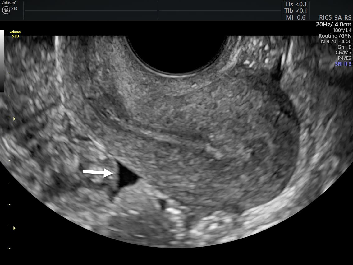 Diagnosing The Cause Of And Measuring Cul De Sac Fluid Empowered Women S Health