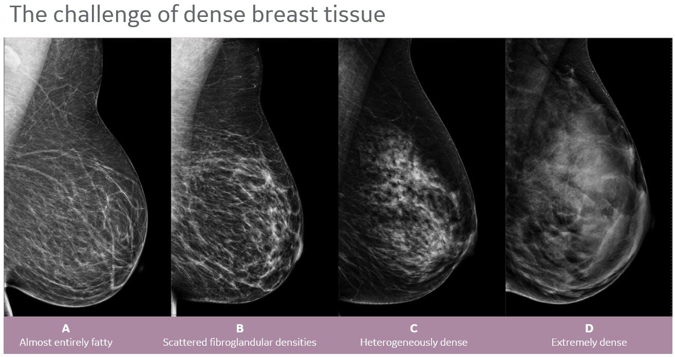 breast ultrasound 3d mammography birads density lives cancer screening saving combining