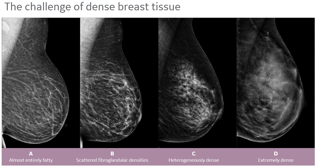 Saving Lives With 3d Breast Ultrasound Mammography Empowered Women S Health