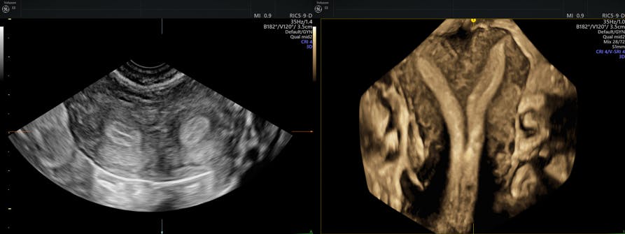 Uterine Lesions Ultrasound Empowered Womens Health