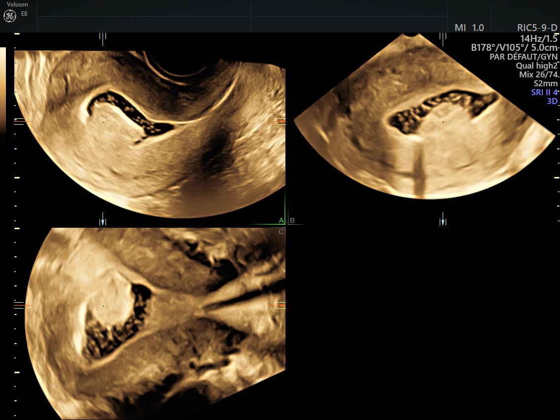 Ultrasound Images Of The Submucosal Fibroid A Initial | My XXX Hot Girl