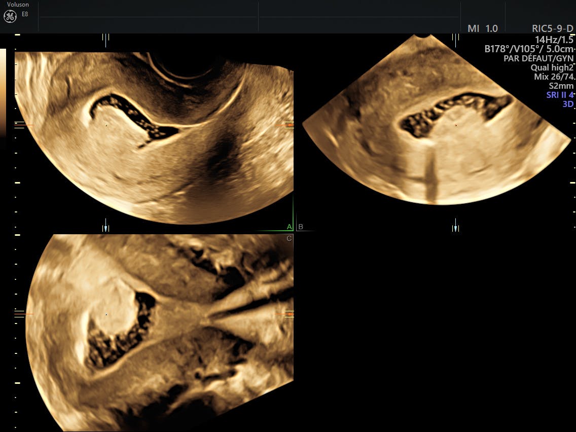 Ultrasound Fibroids | Empowered Women's Health