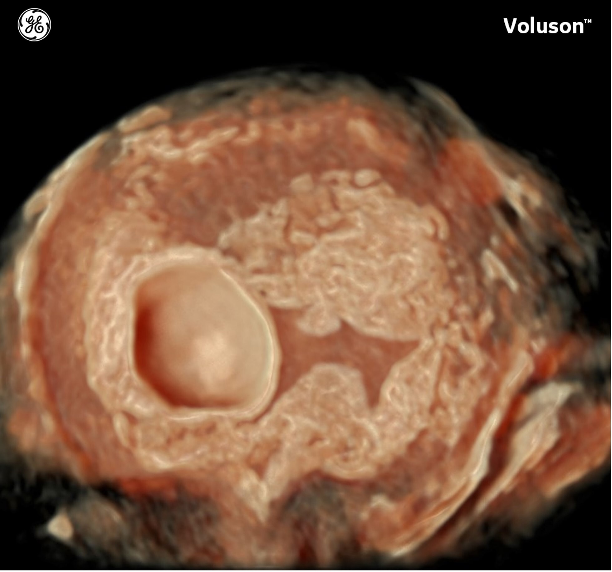 First Trimester Bleeding in IVF Pregnancies - Sneh Hospital