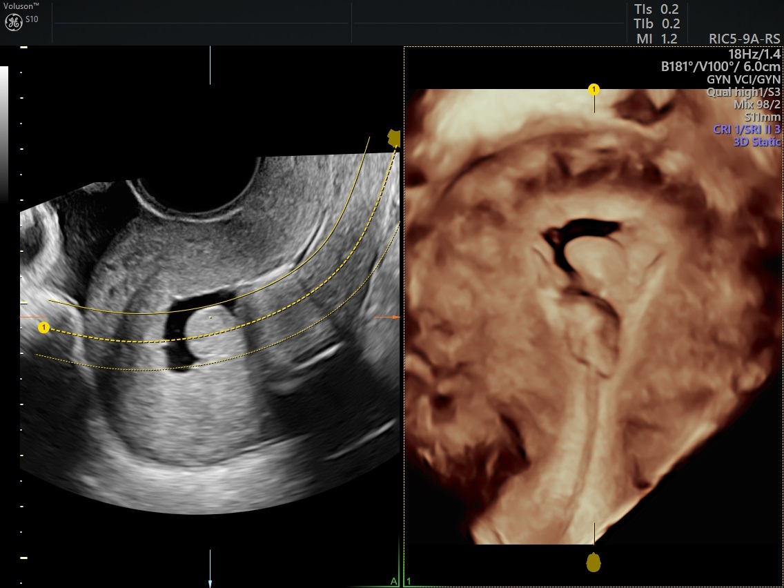 Using Gis Or Sis For Menorrhagia Ultrasound Empowered Womens Health 