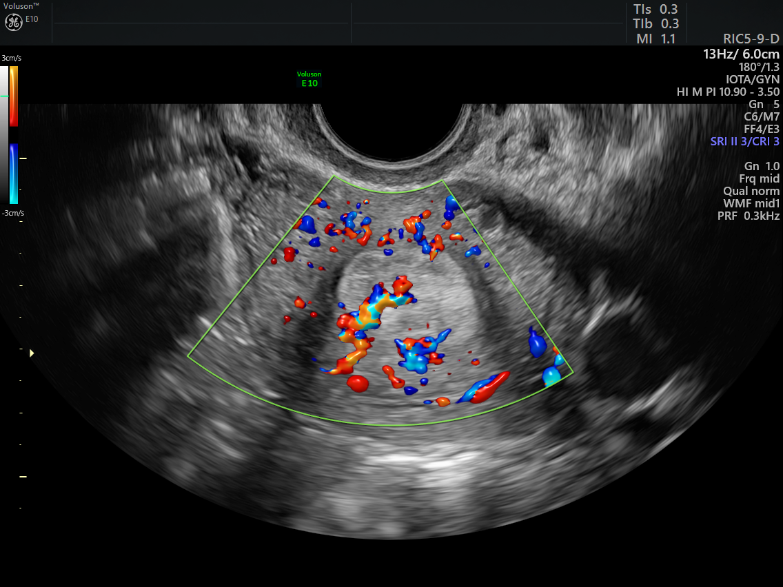 Using Color Doppler Ultrasound For Endometrial Pathology Empowered Womens Health 3418