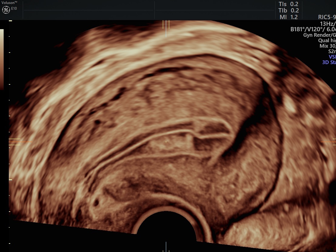 Postmenopausal Bleeding Treatment: The Power of Ultrasound