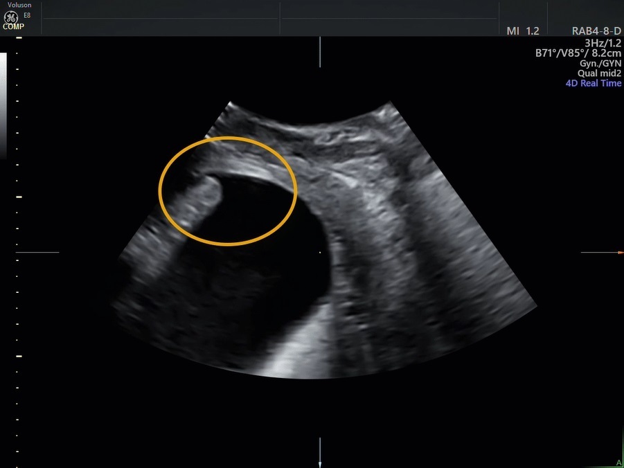 Female Urethral Diverticulum: Diagnosis, Treatment and Outcome