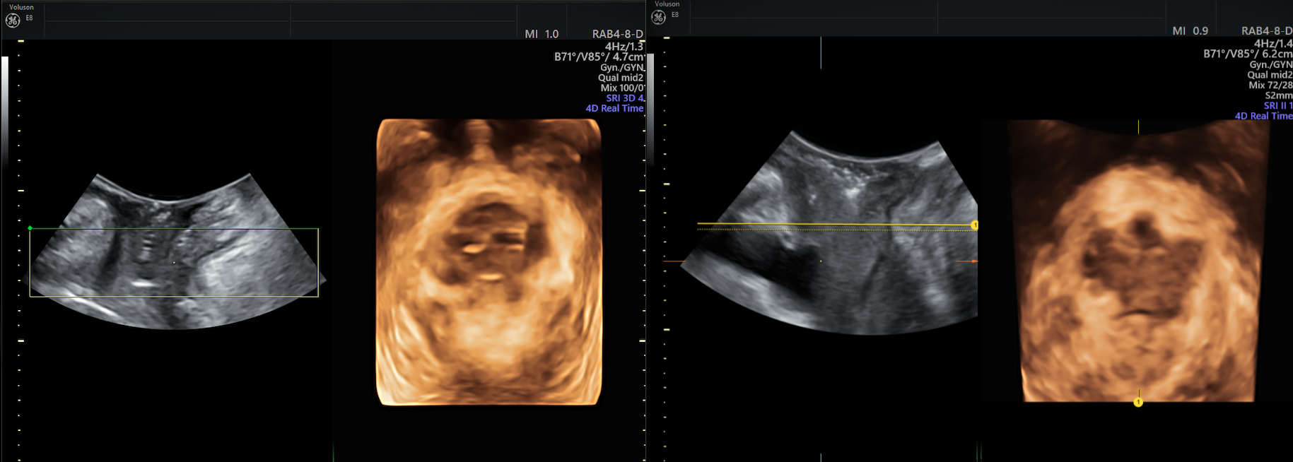 Bladder prolapse into vagina, Radiology Case