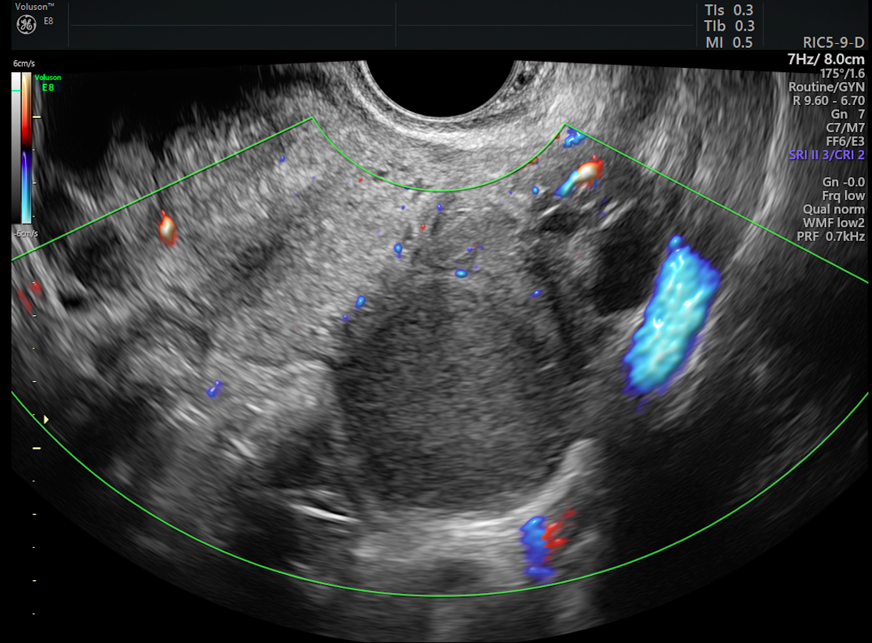 Assessing Deep Infiltrating Endometriosis With Ultrasound | Empowered ...