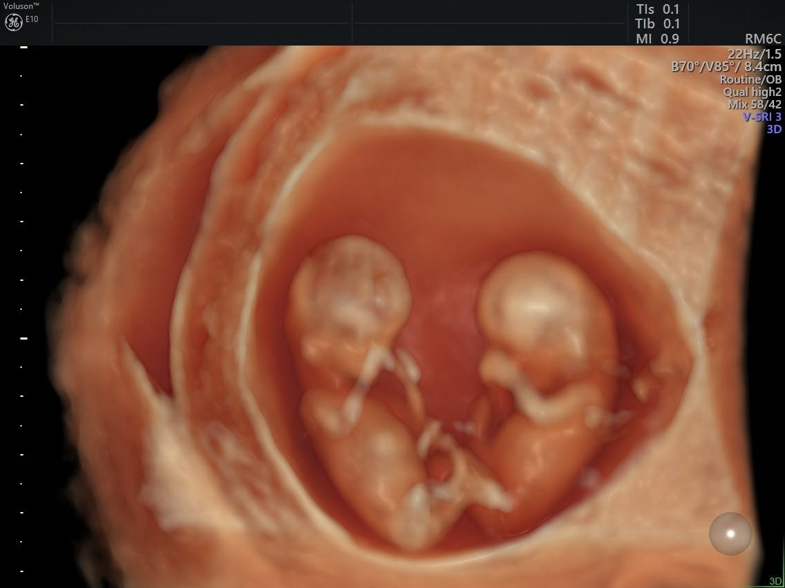 IVF Success Rate of Multiple Versus Single Embryo Transfer Empowered