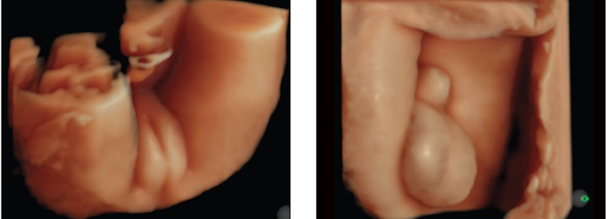 Fetal Sex Evaluation by cfDNA and Ultrasound Empowered Women s  