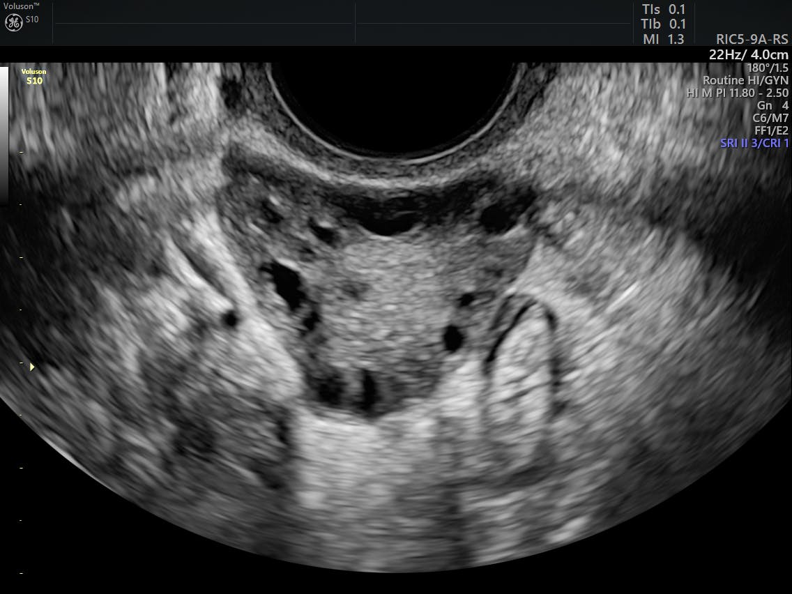 Are the Rotterdam Criteria Still Relevant in PCOS Diagnoses