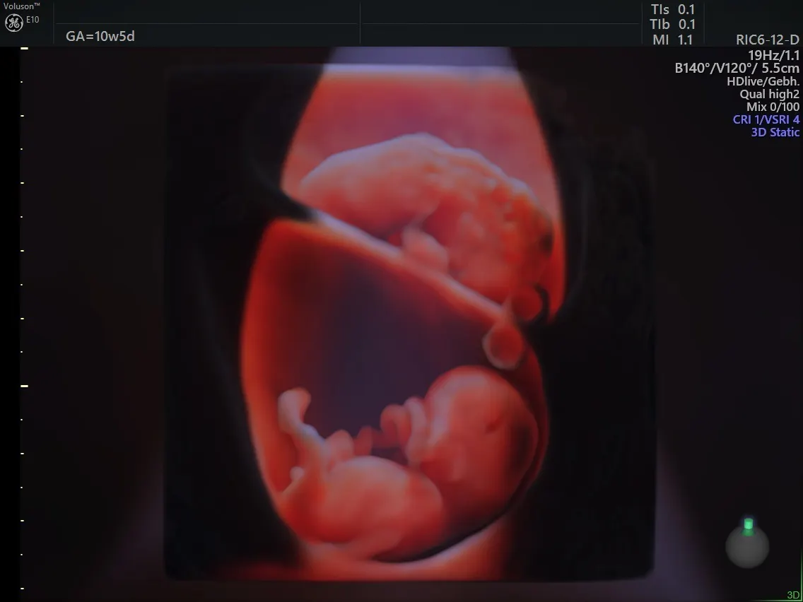 Confirming Multiple Gestations Using Ultrasound Empowered Women S Health