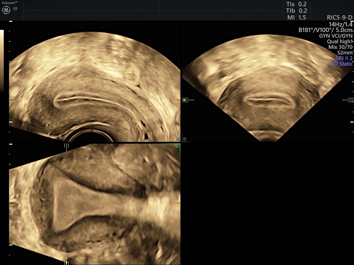 Predicting the risk of endometrial cancer in postmenopausal women