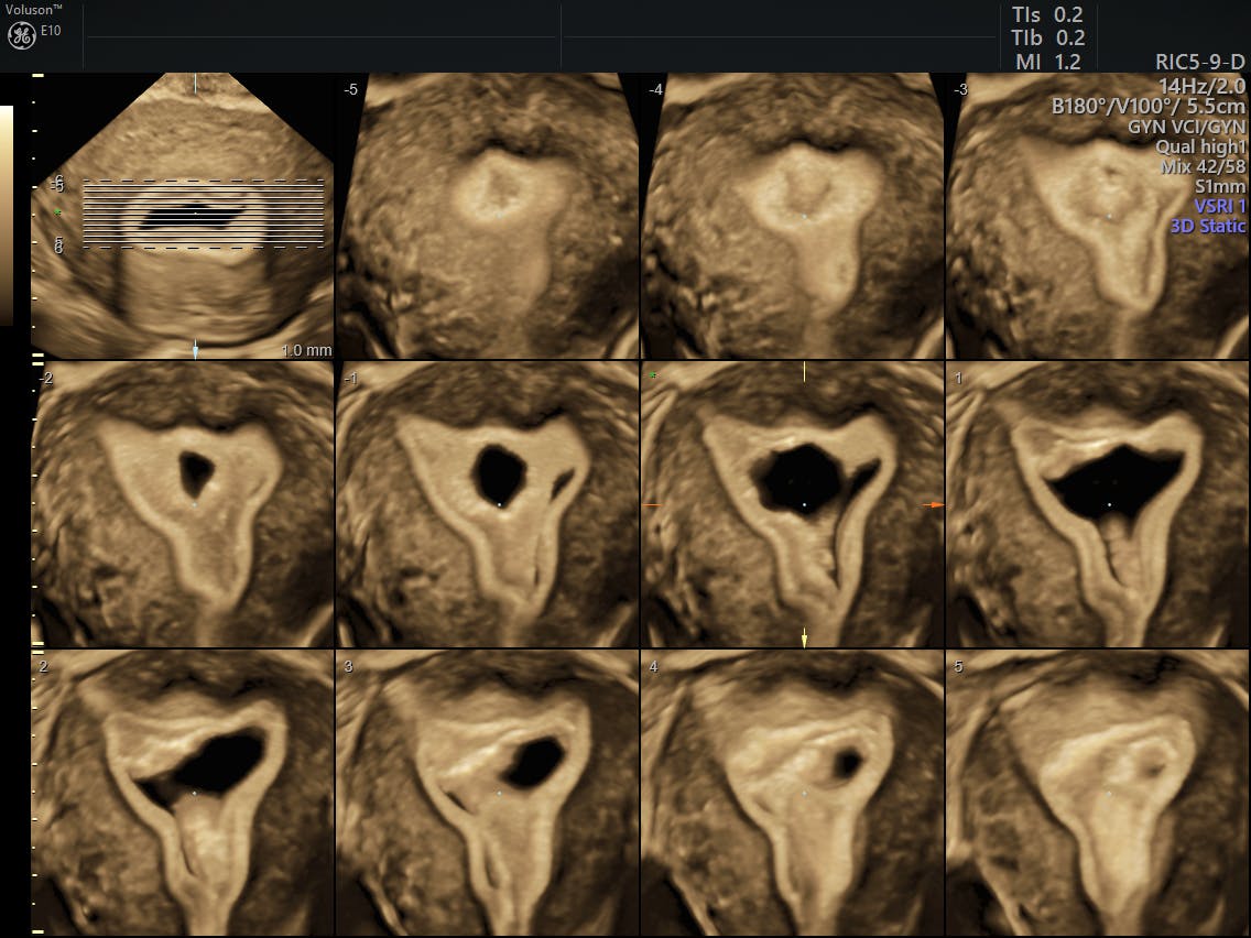 Diagnostic Tools for Postmenopausal Bleeding Empowered Women's Health