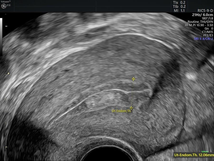 Making The Diagnosis With Endometrial Hyperplasia Ultrasound Empowered Womens Health 7713