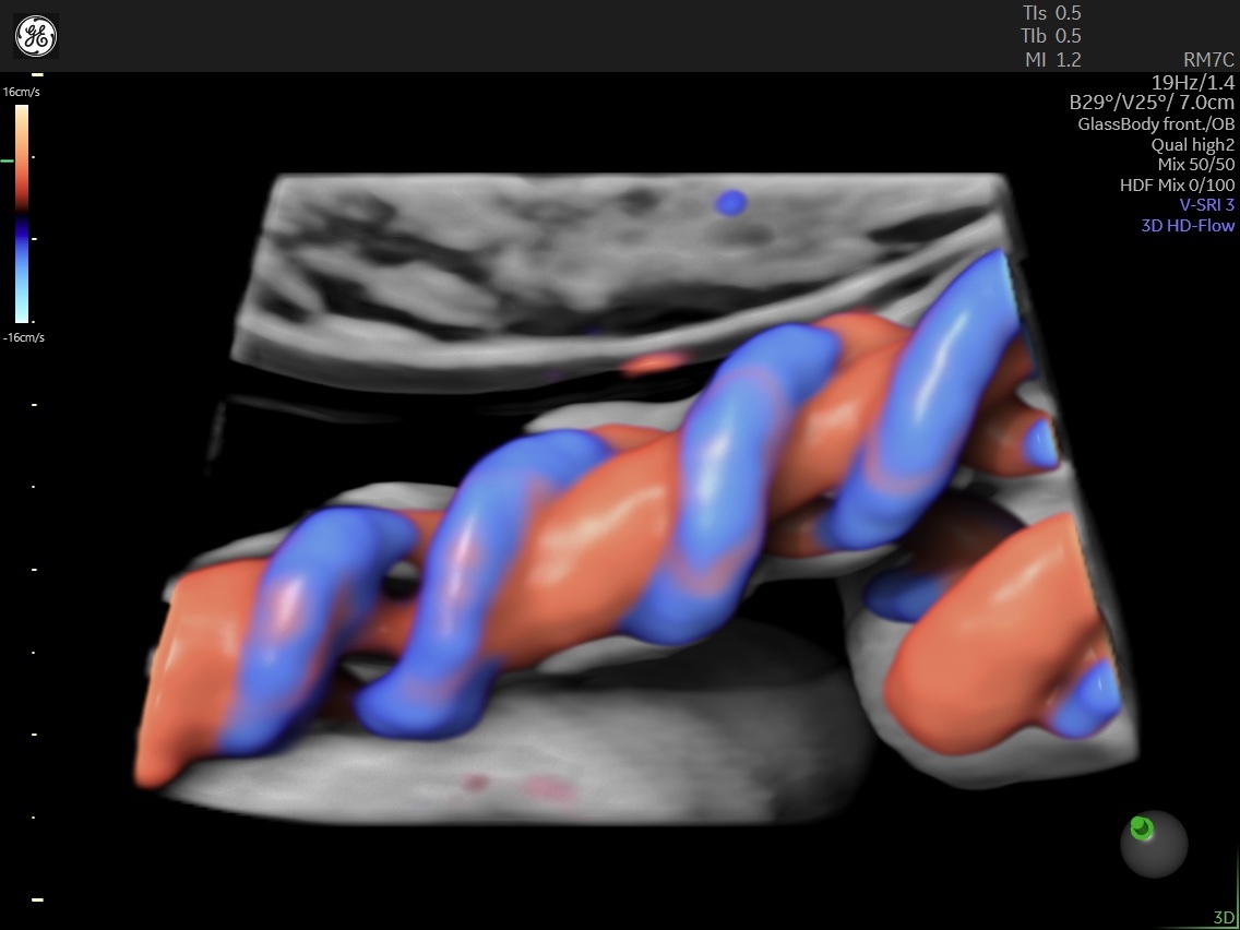 Single Umbilical Artery in Pregnancy and its Significance