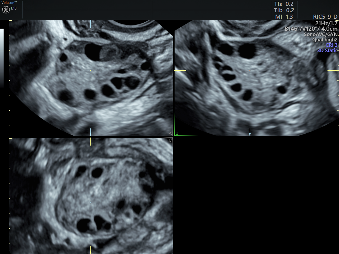 PCOS in Teens | Diagnosing PCOS With Ultrasound | Empowered Women's Health