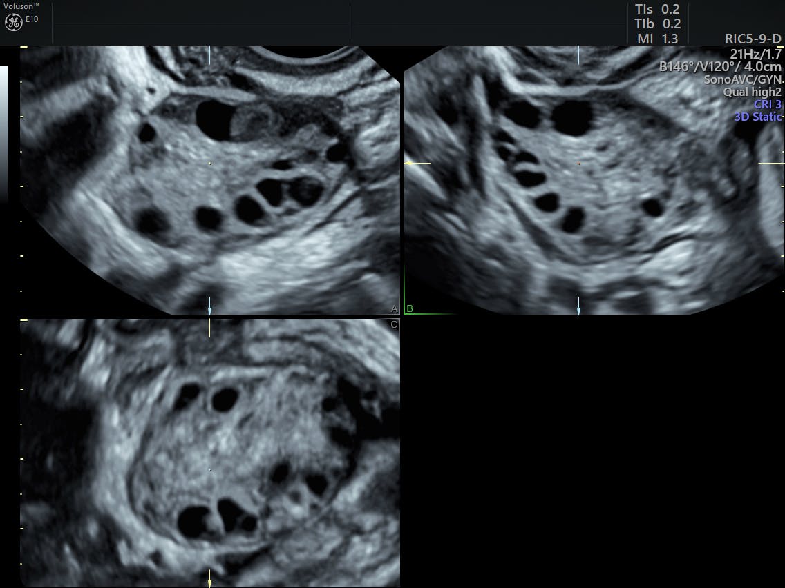 PCOS in Teens | Diagnosing PCOS With Ultrasound ...