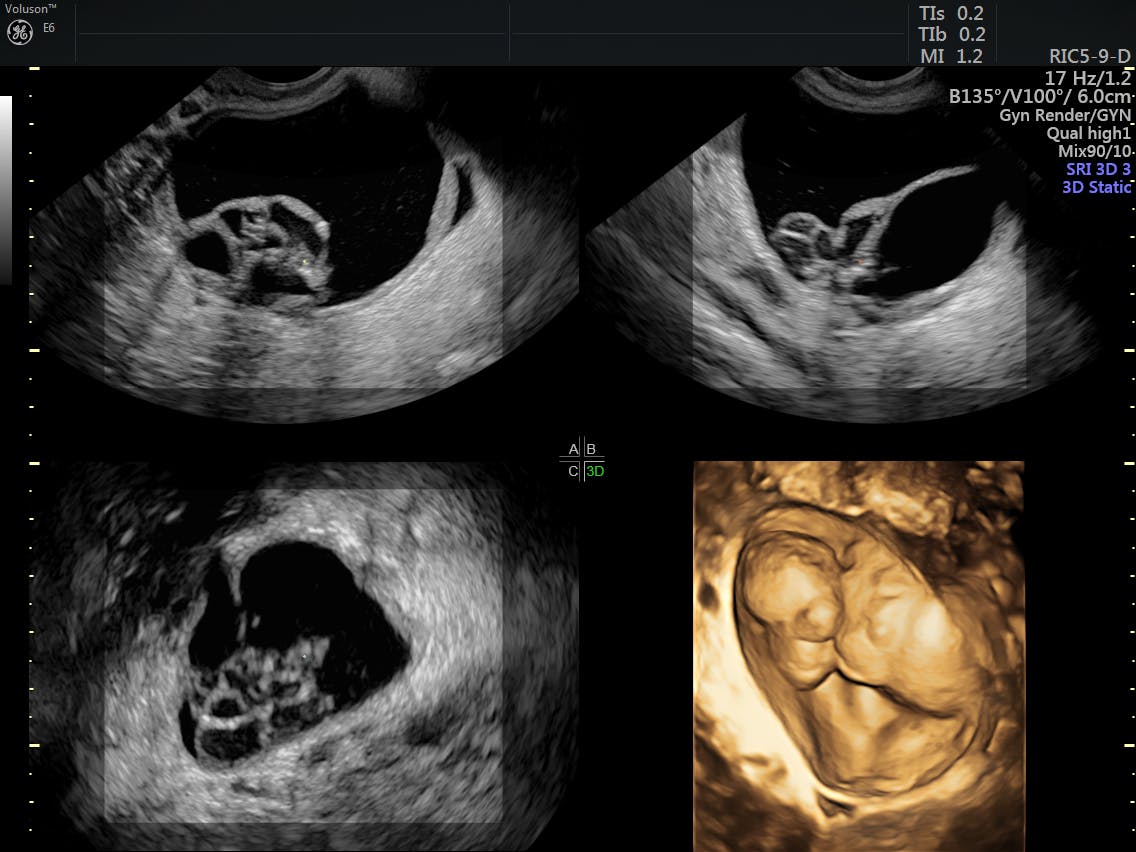 Postmenopausal Hormone Replacement Therapy and Cancer Risks Empowered