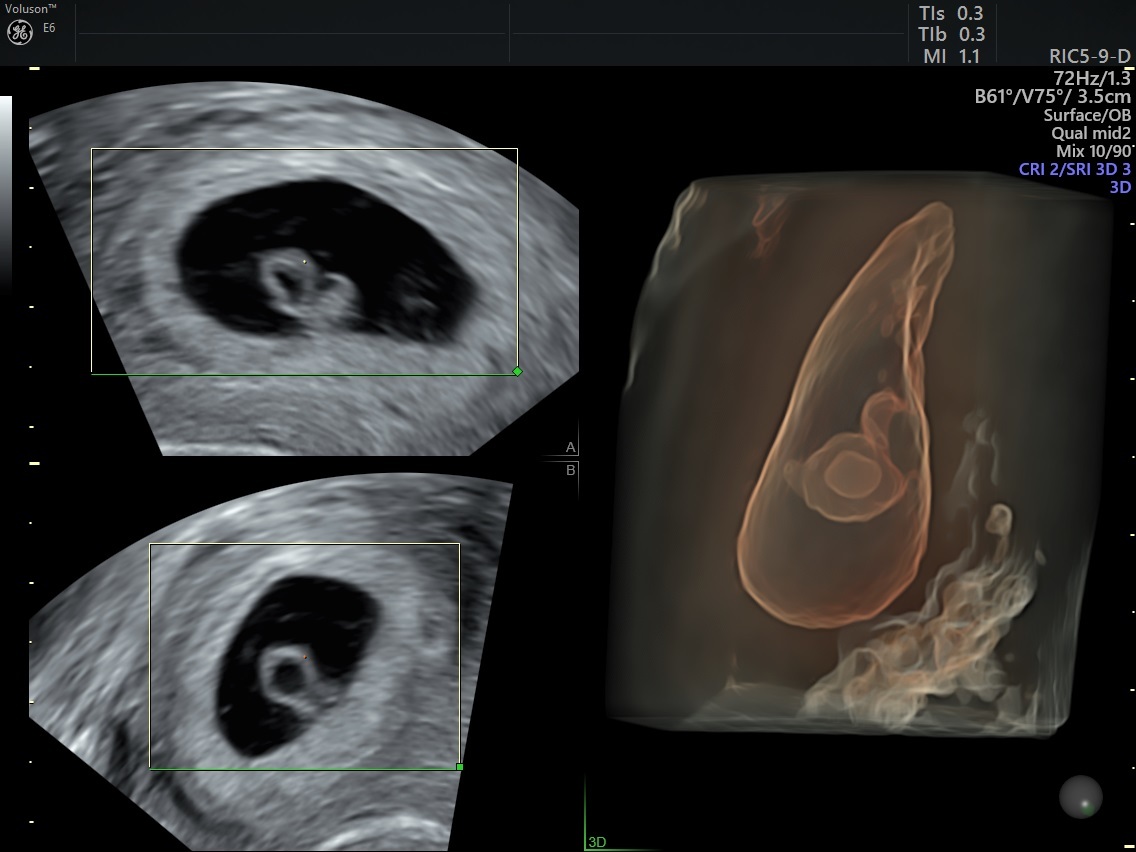 Using a Blood Test and Ultrasound to Confirm Pregnancy