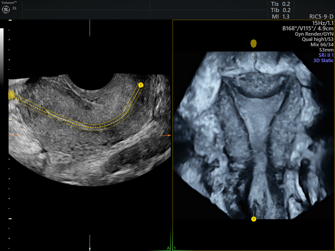 Endometrial Ablation, Causes & Treatments