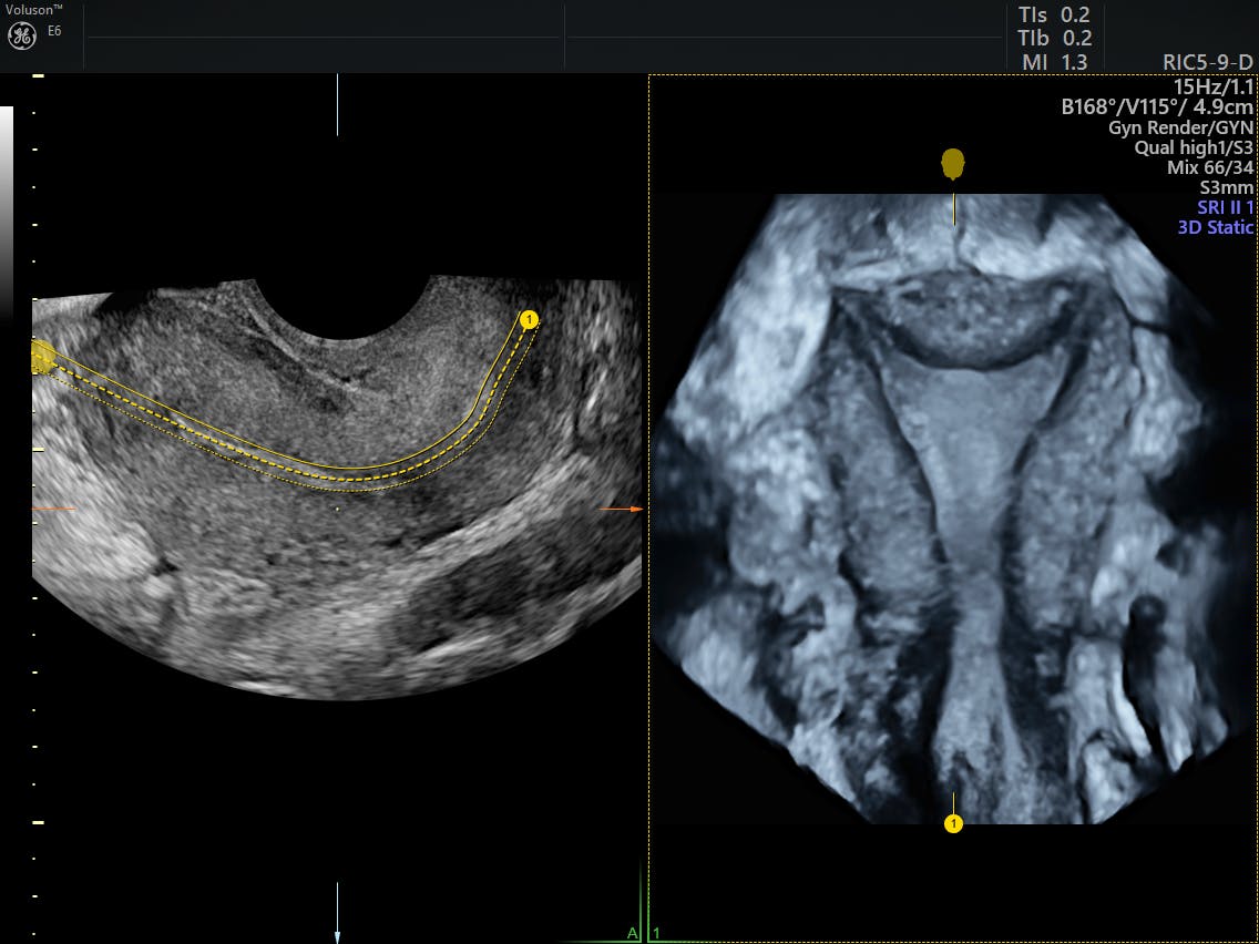 The Benefits of Endometrial Ablation for Endometriosis Empowered