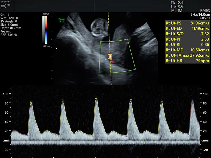 preeclampsia-screening-ultrasound-empowered-women-s-health