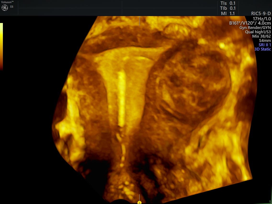 IUD Ultrasound 3D Imaging Helps Accurately Locate Devices Empowered