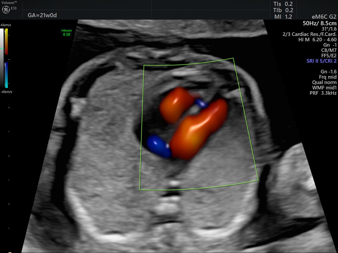 Fetal Vsd Ultrasound