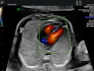 Fetal Heart Image Fetal Heart Rate WAGOAV Fetal Heart Image Fetal Heart Rate WAGOAV