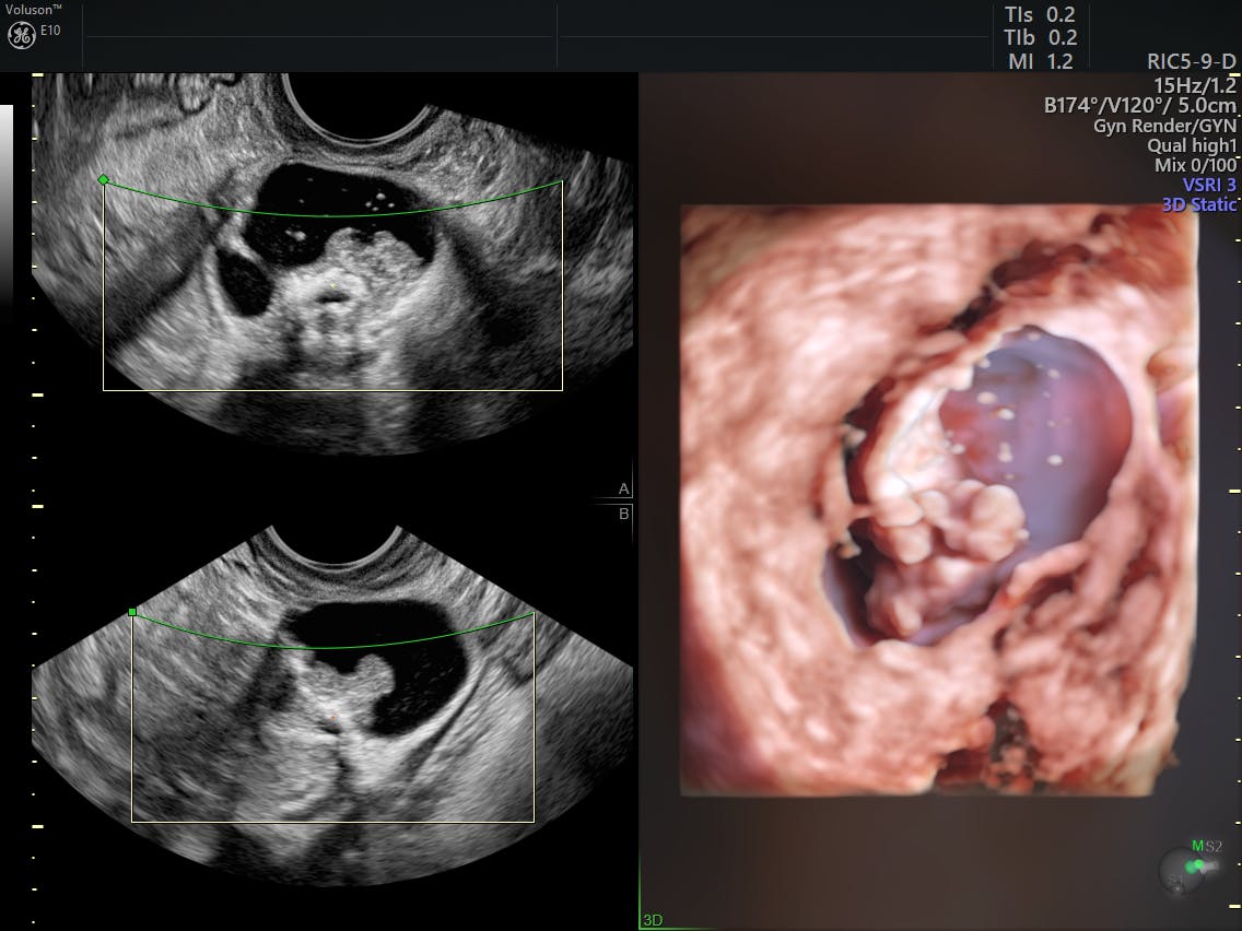 What 3D Ultrasound Can Tell You About Ovarian Cancer