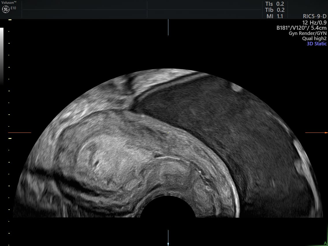 3D Ultrasounds Can Transform Postmenopausal Gynecology | Empowered