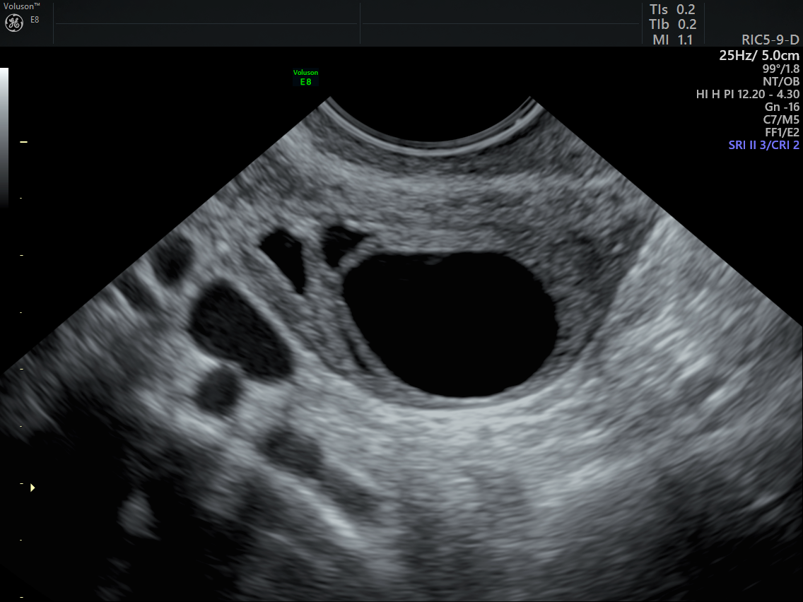 Post Menopausal Simple Ovarian Cysts