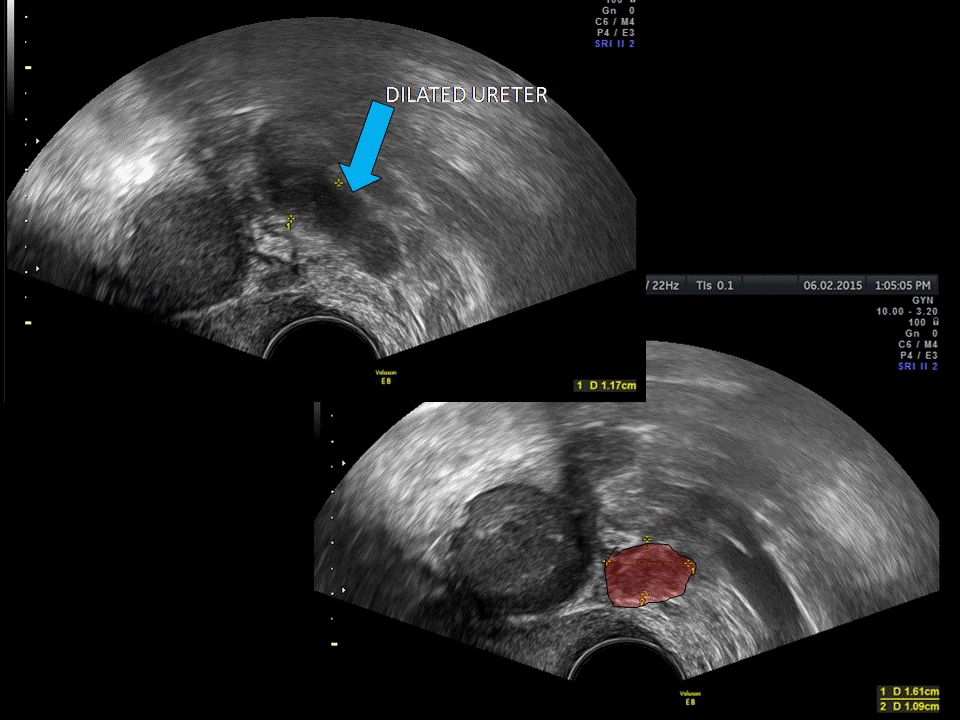 Using Transvaginal Ultrasound for Ureteral Endometriosis Empowered