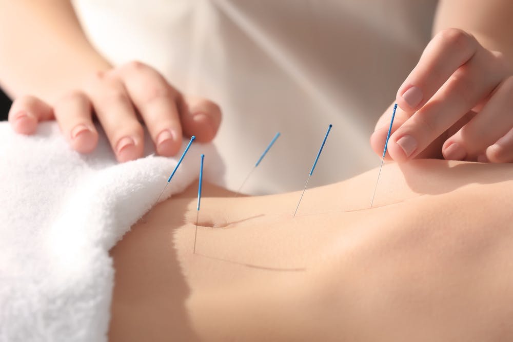 Acupuncture For Fertility: The Role of Holistic Treatment